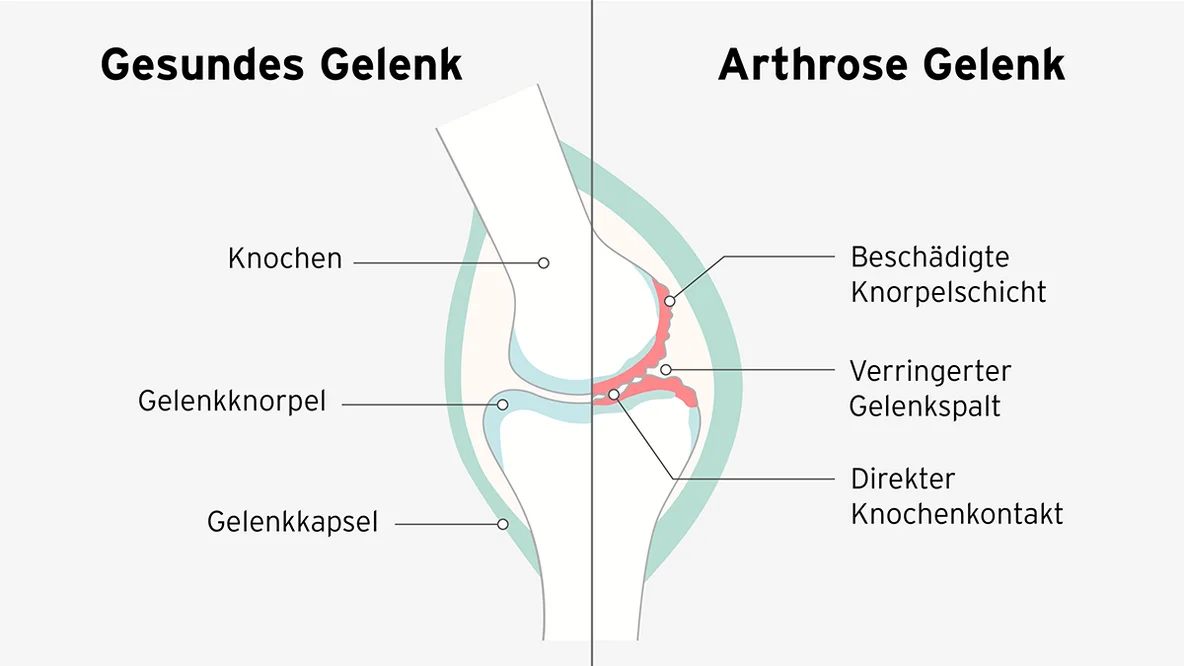 Vergleichsgrafik eines gesunden Kniegelenks zu einem mit Arthrose