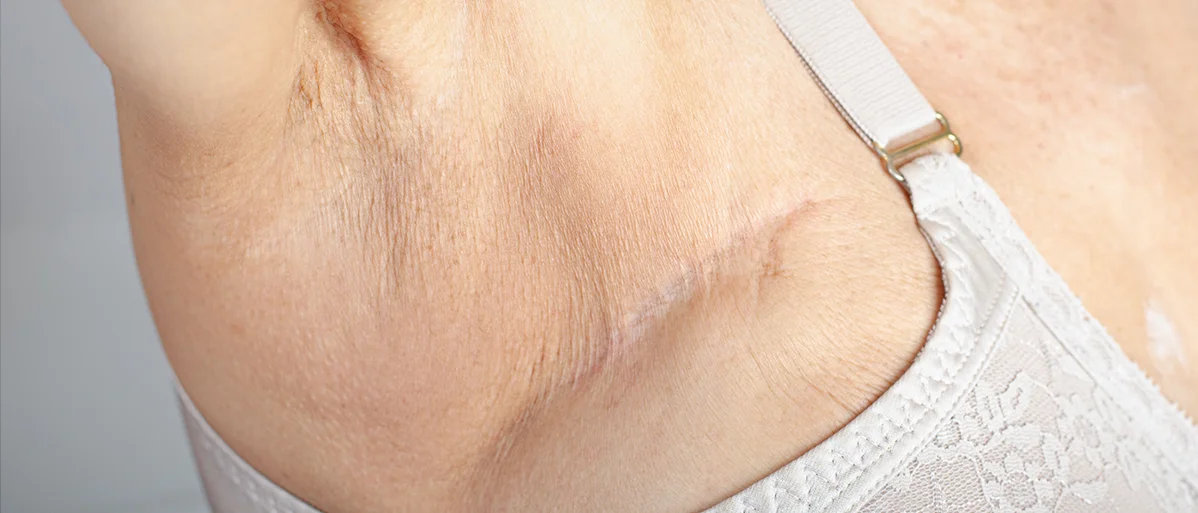 Achsel mit Narbe auf Brusthöhe