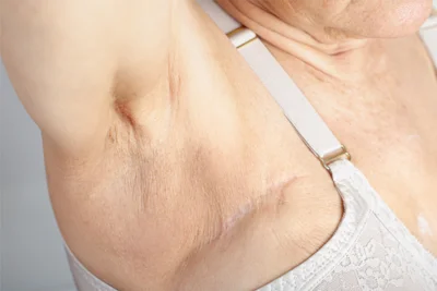 Achsel mit Narbe auf Brusthöhe