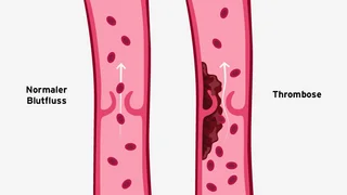 Vergleich eines Blutgefäßes ohne Blutgerinnsel (links) und mit Blutgerinnsel (rechts)