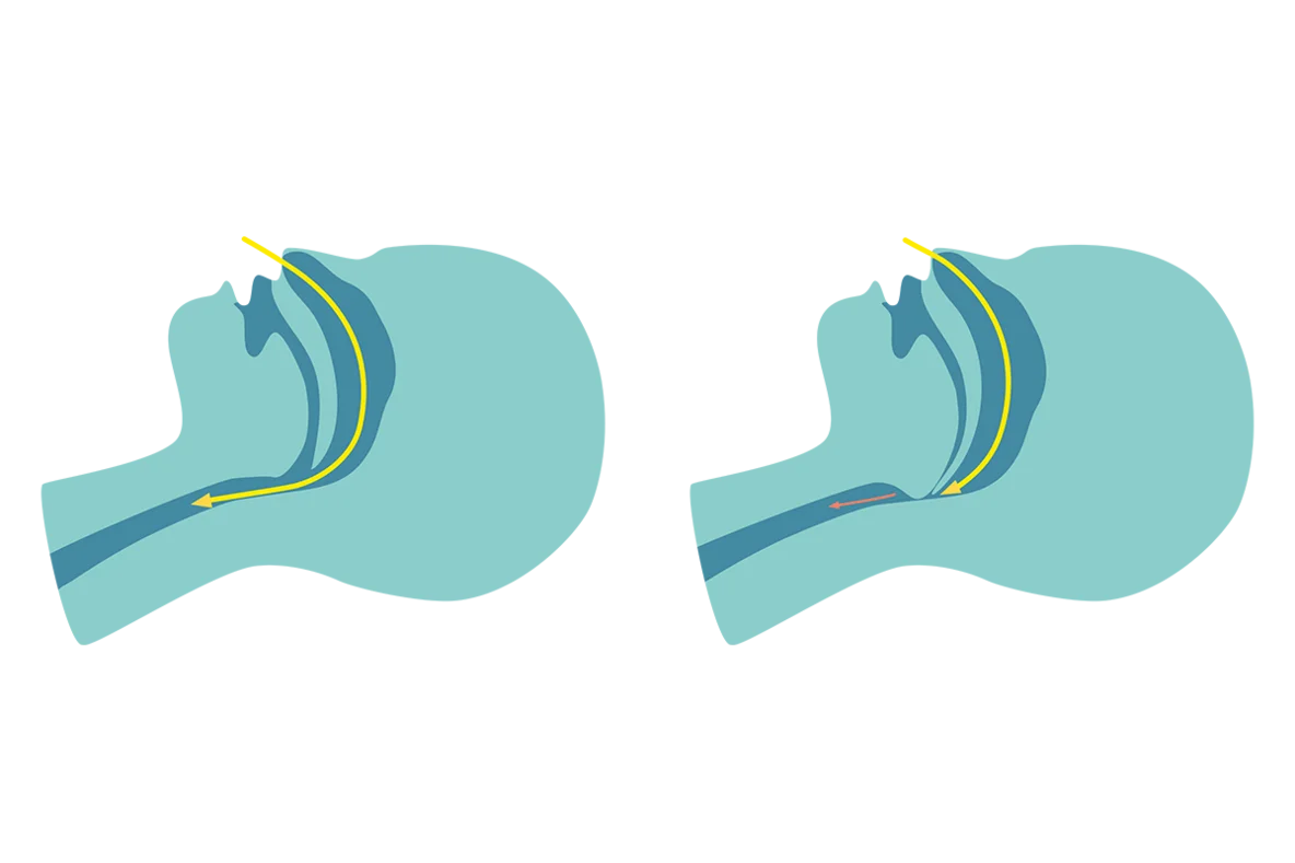 Illustration von Atemwegen beim Schlafen. Links sind die Atemwege frei, rechts sieht man, wie ein Teil der Atemwege blockiert ist.