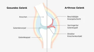 Vergleichsgrafik eines gesunden Kniegelenks zu einem mit Arthrose