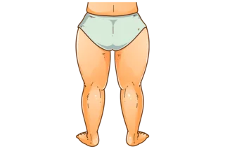 Grafische Darstellung eines Lipödems