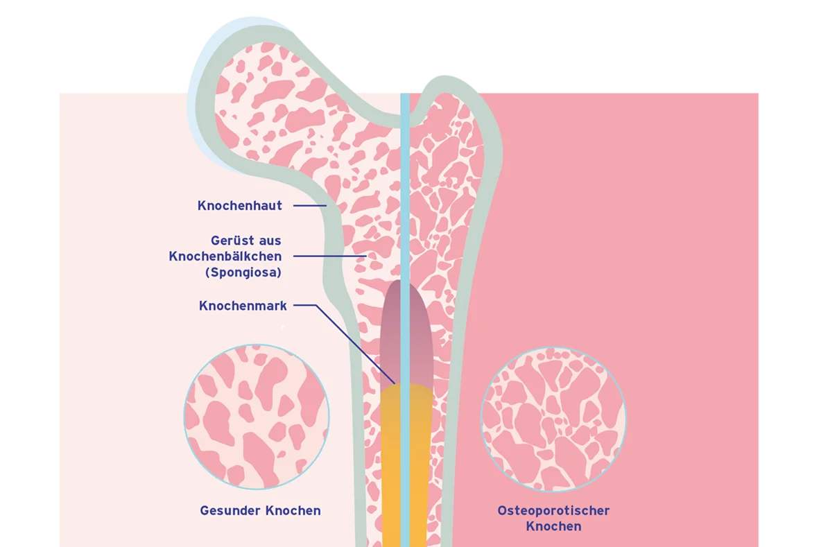 Grafischer Vergleich zwischen einem gesunden Knochen und einem osteoporotischen Knochen
