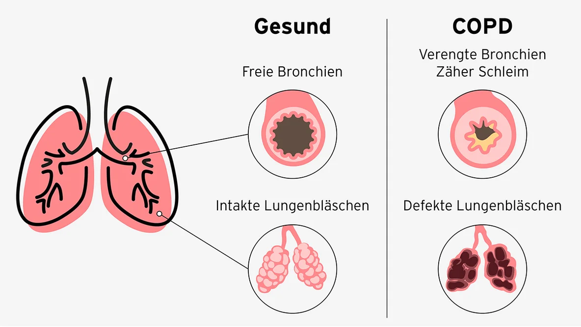 Infografik zur Darstellung einer Lunge mit COPD (Schleim, verengte Bronchien, geschädigte Lungenbläschen) und einer gesunden Lunge.