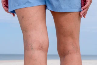 Zwei Beine mit deutlichen Besenreiser. Im Hintergrund erkennt man eine Strand-Szenerie